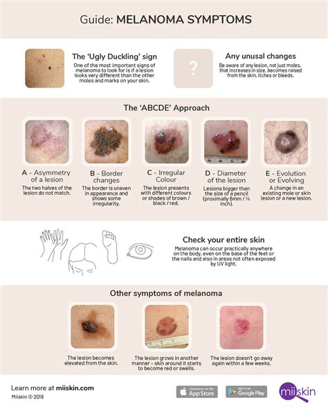 Melanoma Symptoms And Signs Extensive Guide