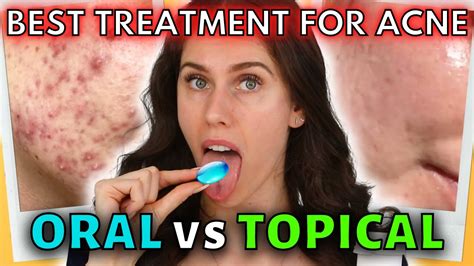Oral Vs Topical Acne Medications Which Is Best For You Youtube