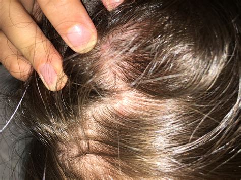 Was Ist Das Auf Meiner Kopfhaut Roter Fleck Dermatologie