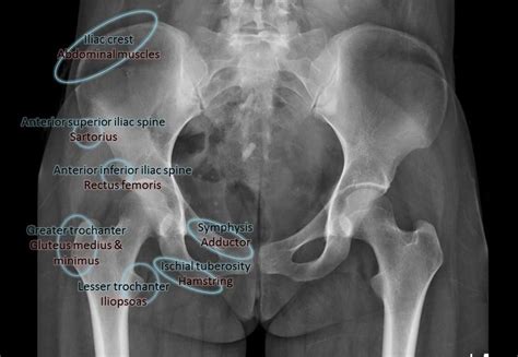 Pelvic Apophyseal Avulsion Fractures Diagram Radiology Case