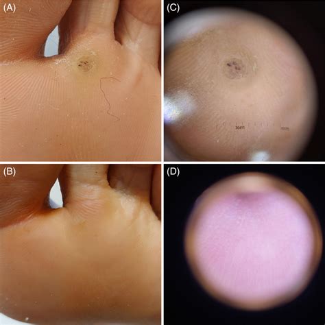 Treatment Of Wart With Cryotherapy Clinical View A Before