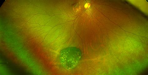 Sonoran Desert Eye Center Congenital Hypertrophy Of The Retinal