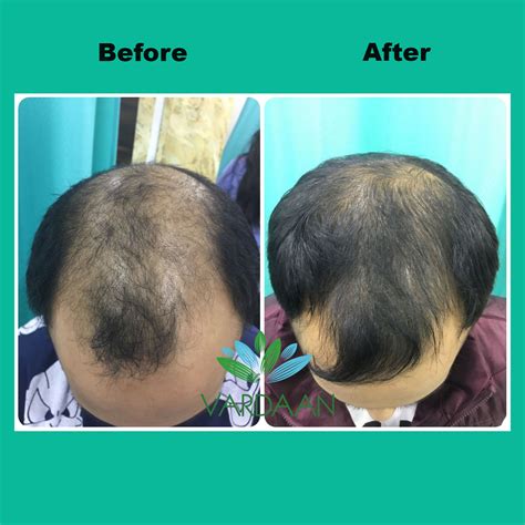 Best Prp Hair Treatment Clinic In Delhi Prp Treatment Cost In Delhi