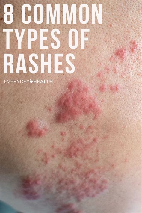 8 Common Types Of Rashes Types Of Rashes Common Skin Rashes Types Of Skin Rashes