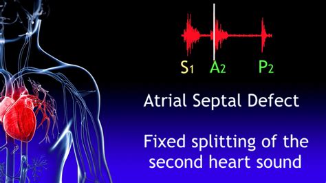 Fixed Splitting Of The Second Heart Sound Asd Youtube