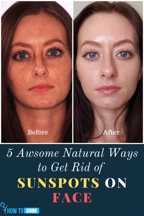 5 Awsome Natural Ways To Get Rid Of Sunspots On Face Howtocure Sunspots On Face Sunspots