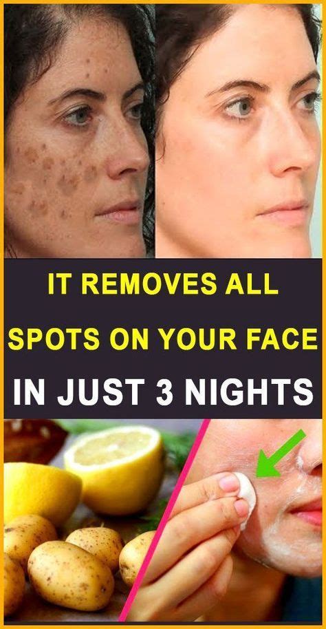 How To Remove Dark Spots On Face And Pimples Howtoremvo