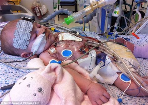Christopher malaisrie, md, and witness open heart surgery by one of the best cardiology and heart surgery programs. Youngest ever baby to undergo open heart surgery goes home for the first time | Daily Mail Online