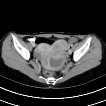 Uterus Didelphys Radiology Reference Article Radiopaedia Org