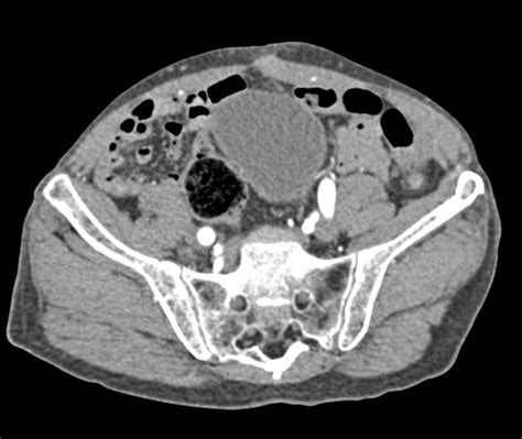 Right Hip Joint Effusion And Normal Cta Musculoskeletal Case Studies
