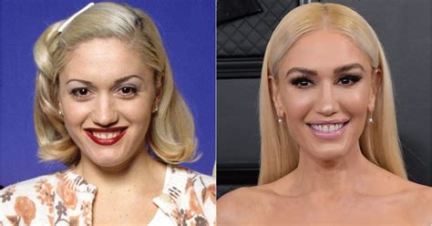 Has Gwen Stefani Had Plastic Surgery See What Experts Think