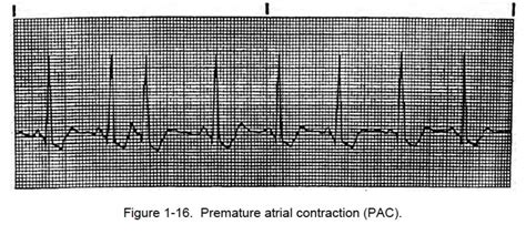 Figure Premature Atrial Contraction Pac Cardiac Rhythm