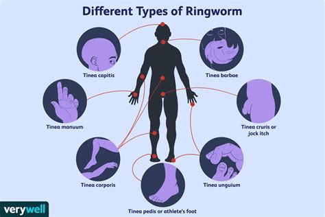 Ringworm Causes Symptoms And Treatment