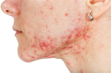 Acne On Chin Hormonal Cystic Meaning And Cures Skincarederm
