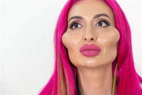 Model With Worlds Biggest Cheeks Shows What She Looked Like Before