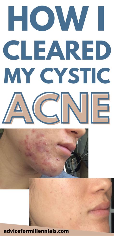 How I Cleared My Cystic Acne Without Accutane Bad Acne Hormonal Acne