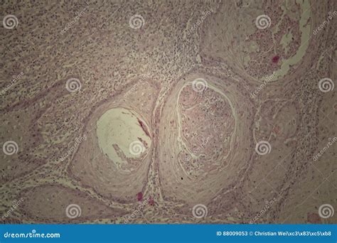 Human Squamous Cell Carcinoma Tissues Affected By Cancer Cells Under A