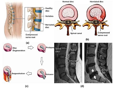 There are several methods commonly used today. Lumbar Disc Herniation (a) Showing herniated disc at L4/L5 level 14;... | Download Scientific ...