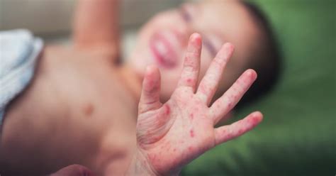 hand foot and mouth disease fv hospital