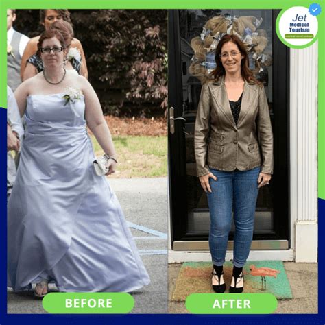 Gastric Bypass Before And After Pictures 2022