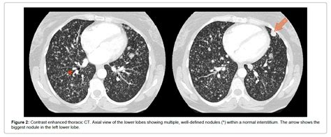 Radiology Lower Lobe