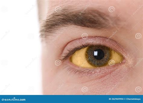 Man With Yellow Eyes On White Background Closeup Symptom Of Hepatitis