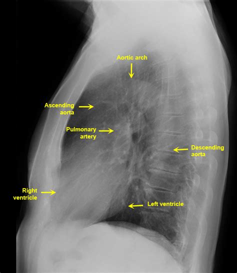 lateral normal plain chest ray anatomy radiograph abdomen radiology male xray heart cardiac pediatric cxr imaging labelled schools rays nursing