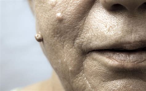 How To Get Rid Of Warts On The Face