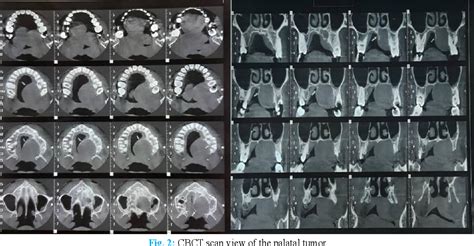 Figure 2 From Surgical Treatment Of A Huge Pleomorphic Adenoma In The