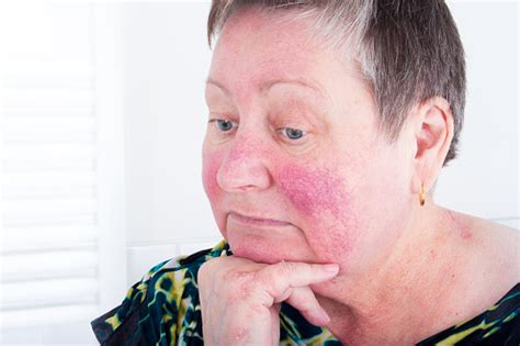 Rosacea Facial Skin Disorder Portrait Of Unhappy Woman Stock Photo
