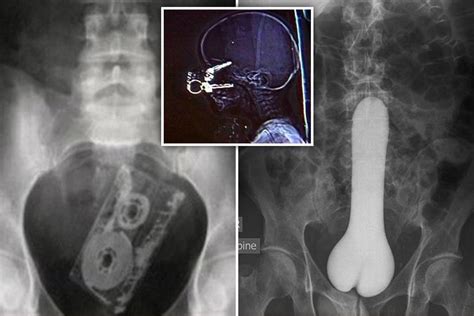 X Ray Pictures Of The Most Embarrassing Place To Get Something Stuck