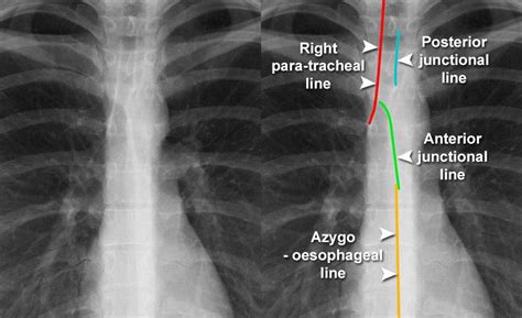 Chest X Ray Quality Normal Chest X Ray Detail