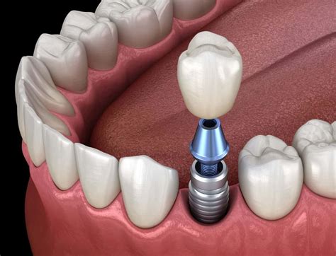 Dental Implants Gold Coast Costs Options Tooth Implant Faqs