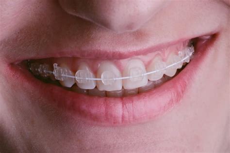 The Truth About Ceramic Braces Parkersburg WV Orthodontist