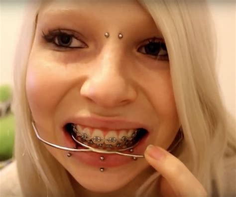 Braces Braceface Metalbraces Girlswithbraces Headgear Dental Braces Braces Girls Dental