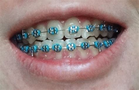 Pin On Braces Colors
