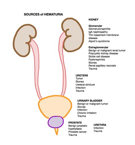 Filesources Of Hematuria By Anatomic Locationpng Wikem