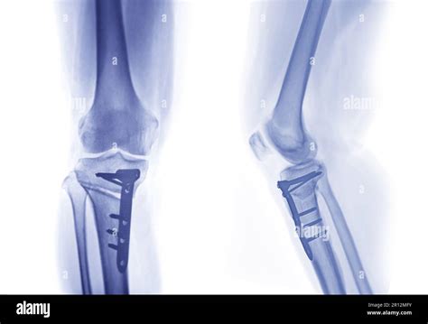 X Ray Image Of Right Knee Ap And Lateral View Showing Total Knee