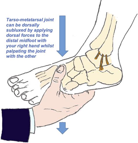 Lisfranc Fracture Dislocation A Review Of A Commonly Missed Injury Of