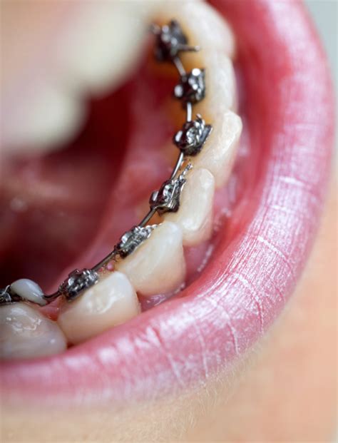 Lingual Braces History And Benefits Belmar Orthodontics