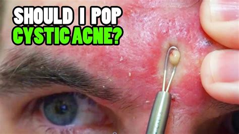 Should You Pop Cystic Acne Pimples And Whiteheads Youtube