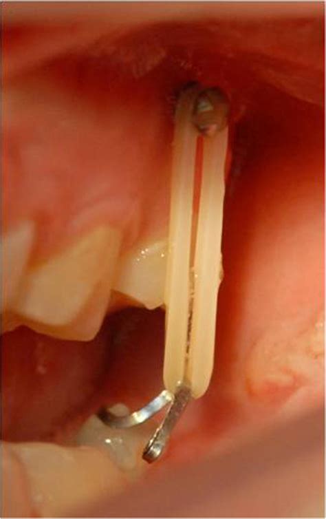 Correction Of Mesially Impacted Lower Second Molar Celebi Journal