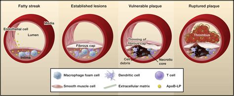 Macrophages In The Pathogenesis Of Atherosclerosis Cell