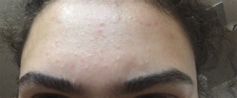 Discolored Skin On The Forehead Causes And Concerns Heidi Salon
