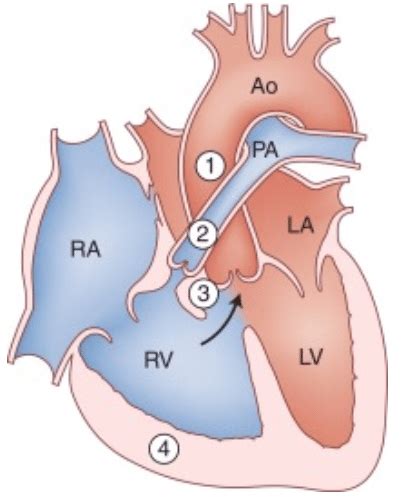 6 Left Panel Tetralogy Of Fallot Characterised By 1 Overriding
