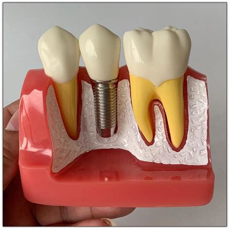 Patient Education Models Dental Teeth Demonstration