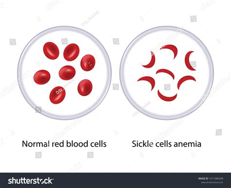 Normal Red Blood Cells Sickle Cells Vetor Stock Livre De Direitos