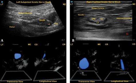 An Ultrasound Image Of A Left Subgluteal Sciatic Nerve Block A With A