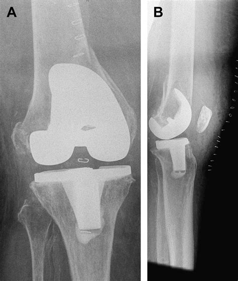 Revision Arthroplasty Preoperative A Anteroposterior And B Lateral