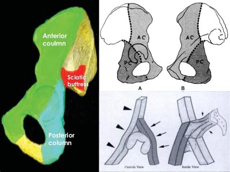 Acetabular Fractures Presentation And Treatment Bone And Spine